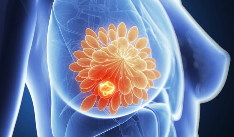 New Discovery In Breast Cancer Treatment Kills ‘Hibernating’ Cells